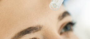 Microneedling pen held above the forehead during treatment