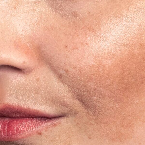 A close view of sun damage and uneven pigment on the cheek