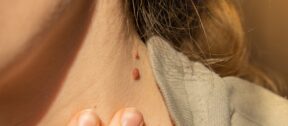A single raised spot being examined close up on the skin