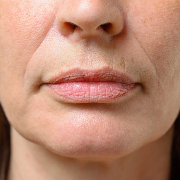 Perioral lines deepening as the lips purse