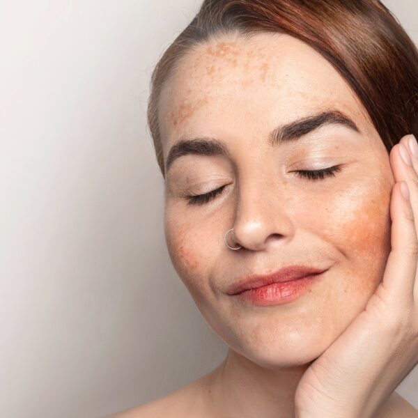 Symmetrical brown patches of chloasma on the face